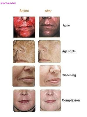 Professional Oxygen Facial Machine For Skin Care