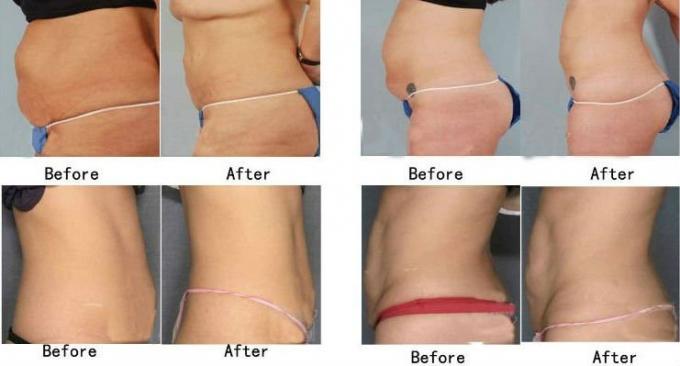 Lipo professionnel de laser de zerona avec de bons résultats